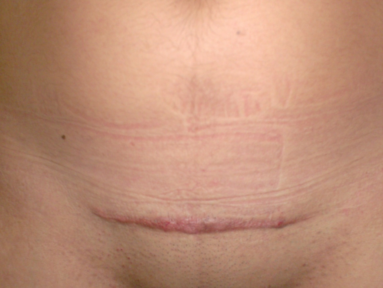 Identidad Brújula Sympton Fisioterapia tras la cesárea. Como mejorar la cicatriz.